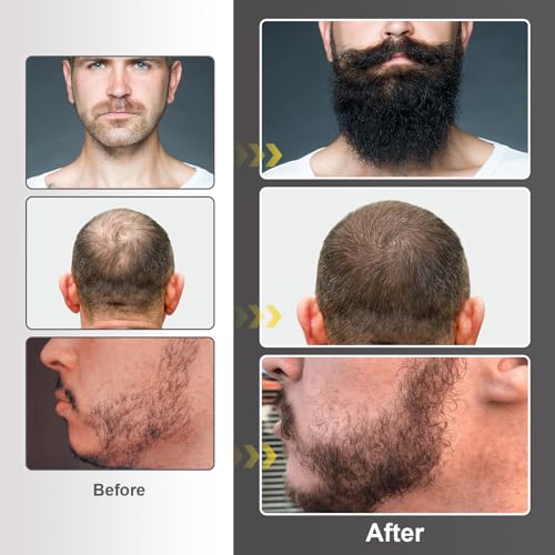 Beard Growth Kit - Beard Kit for Men with Beard Growth Oil (2oz), Beard Balm, Beard Comb, Massager for Spot/Patchy Beard - Christmas, Anniversary, Birthday for Men, Dad, Husband, Boyfriend