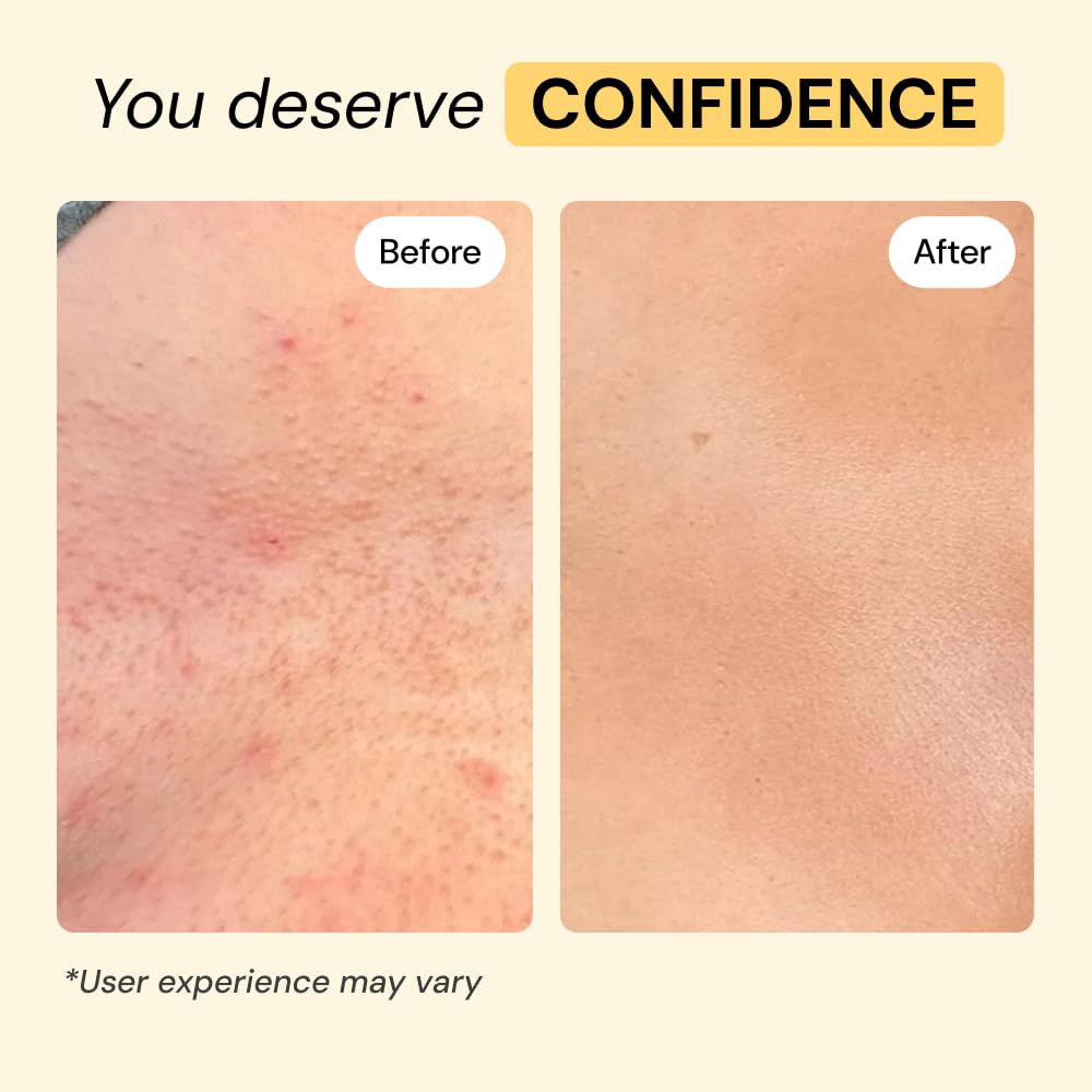 MyMagicHealer Universal Flare Care – Solution for Everyday Skin Flare-Ups | Drawing Salve for Boils & Cysts, Hidradenitis Suppurativa, Folliculitis | Irritated Skin and Chafing Relief 4 oz