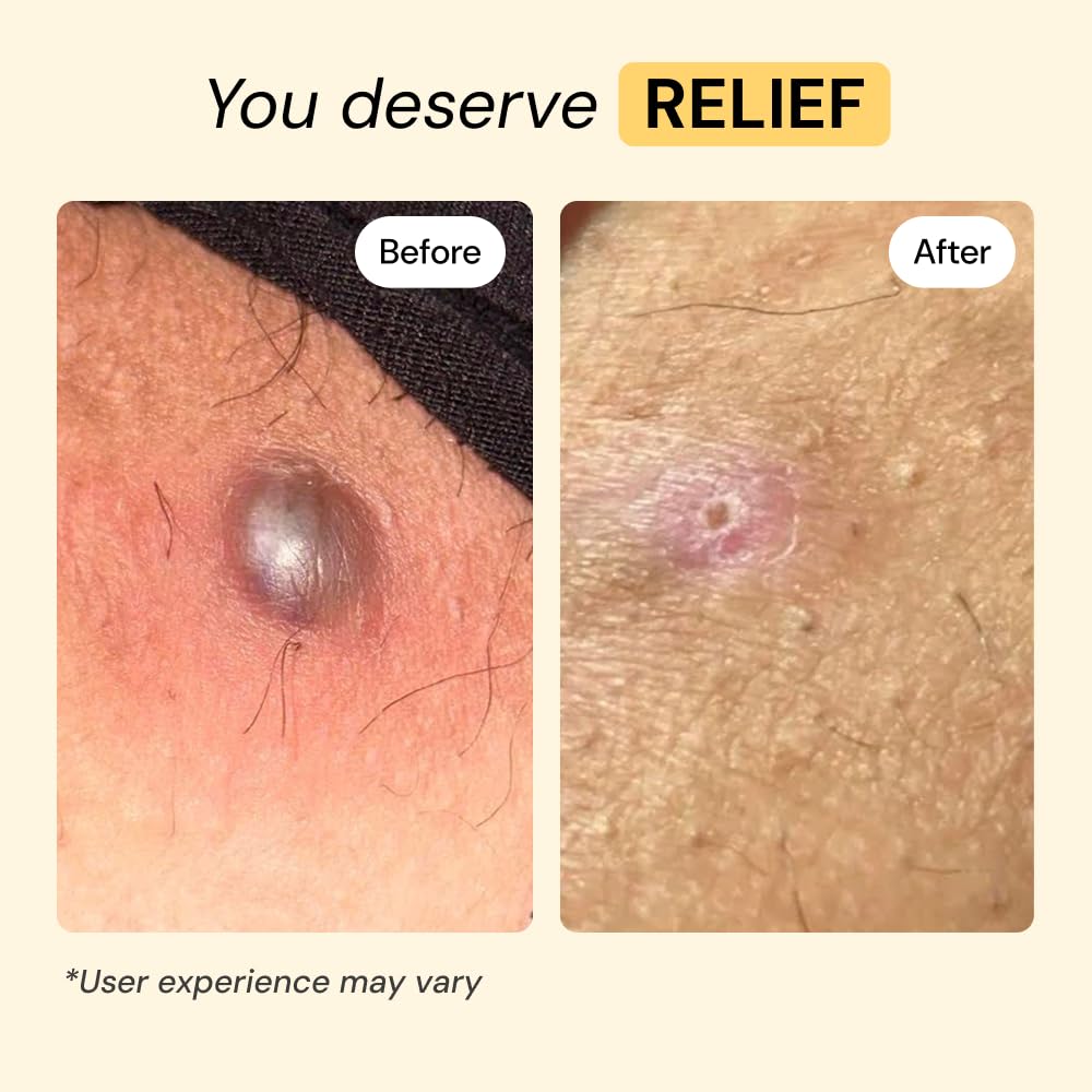 MyMagicHealer Universal Flare Care – Solution for Everyday Skin Flare-Ups | Drawing Salve for Boils & Cysts, Hidradenitis Suppurativa, Folliculitis | Irritated Skin and Chafing Relief 2 oz