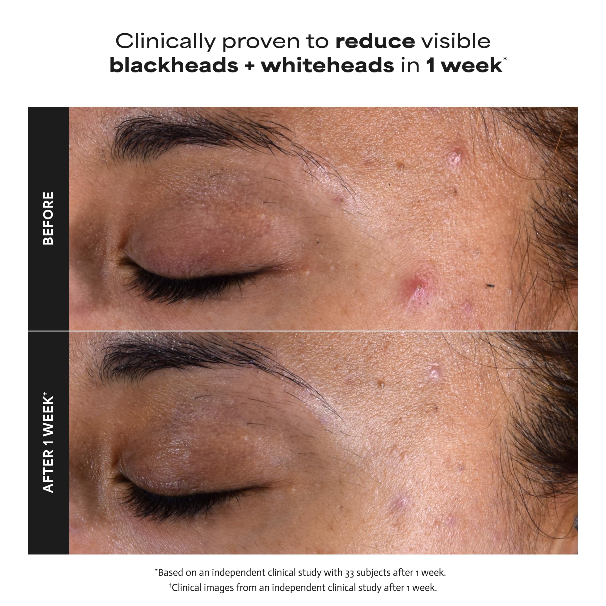 Paula's Choice Skin Perfecting 2% BHA Liquid Salicylic Acid Exfoliant, Gentle Facial Exfoliator for Blackheads, Large Pores, Wrinkles & Fine Lines, Travel Size, 1 Fluid Ounce